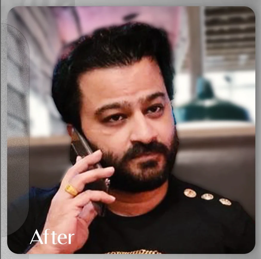 After hairline FUE hair transplant Islamabad