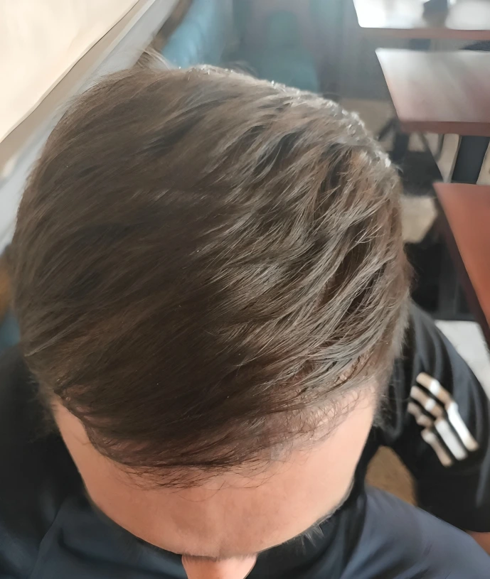 After frontal hair transplant result