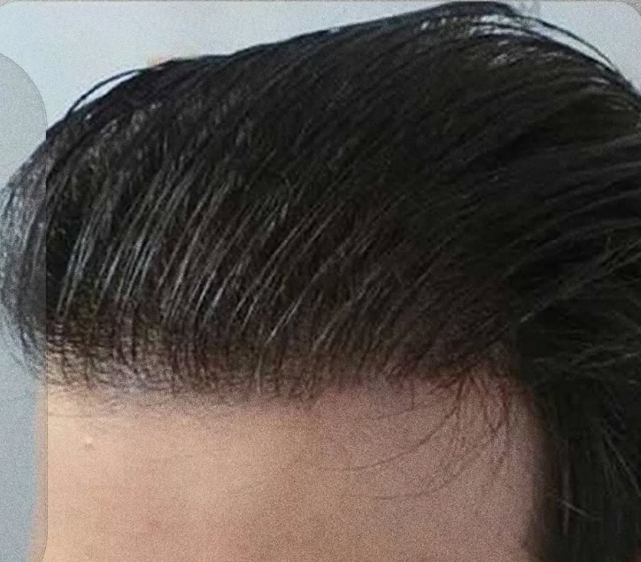 After hairline density after FUE