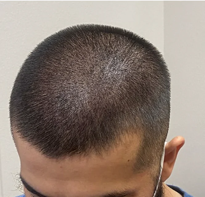 After crown density after hair transplant