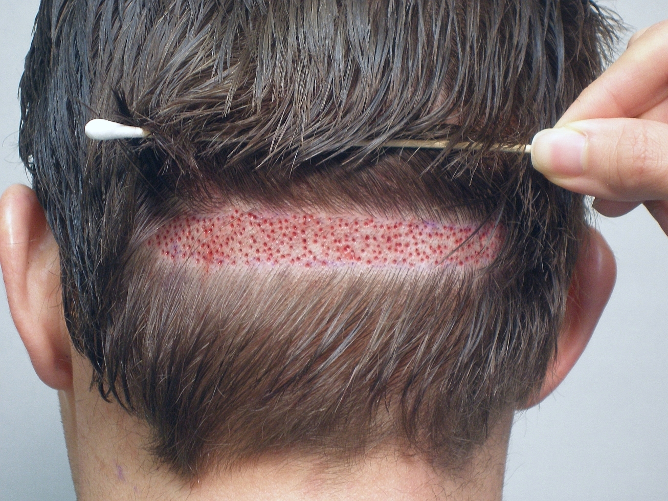 FUT hair transplant strip method at Estheticare Islamabad